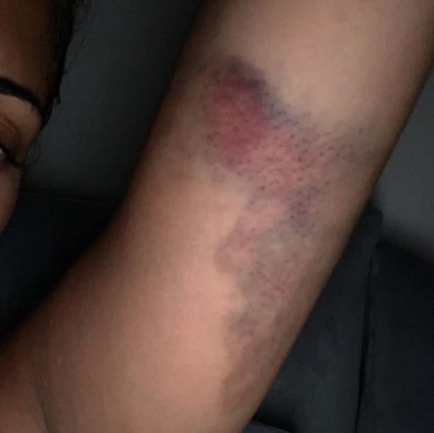 The Love Island star opened up about her experience with domestic abuse and shared this bruised arm photo